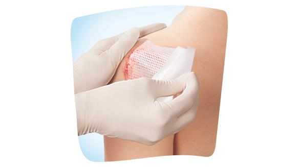 Medico che usa la garza in silicone Cuticell® Contact di Leukoplast per curare un'ustione Medico che usa la garza in silicone Cuticell® Contact di Leukoplast per curare un'ustione